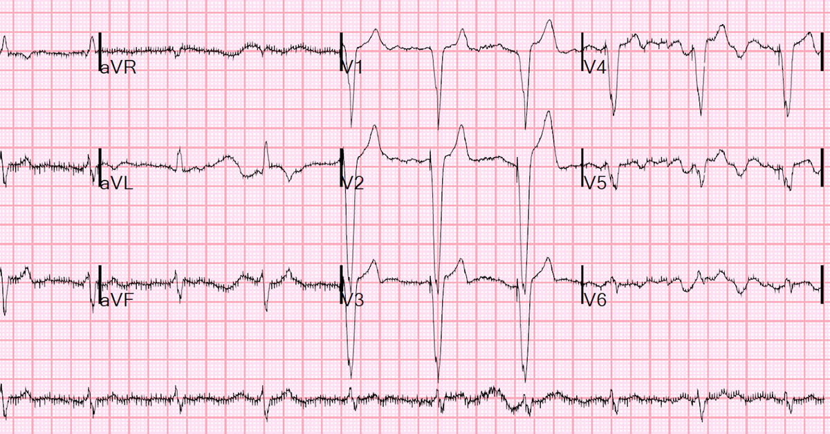 Estimating Undiagnosed Abnormal Heart Rhythm Cases In Older Adults estimating-undiagnosed-abnormal-heart-rhythm-cases-in-older-adults