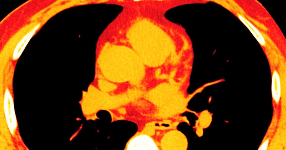 An image of fat around the heart.
