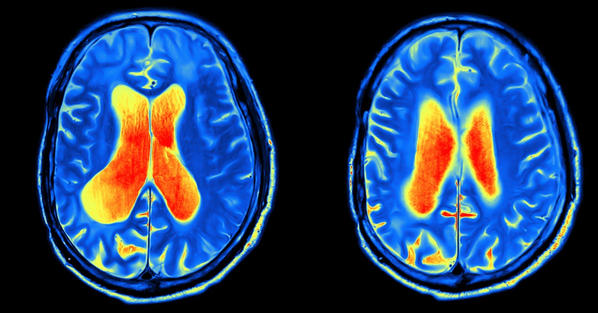 MRI images of brain activity